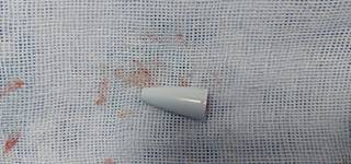 استخراج جسم غريب من الشعب الهوائية لطفل باستخدام المنظار الشعبي بمستشفى الأطفال