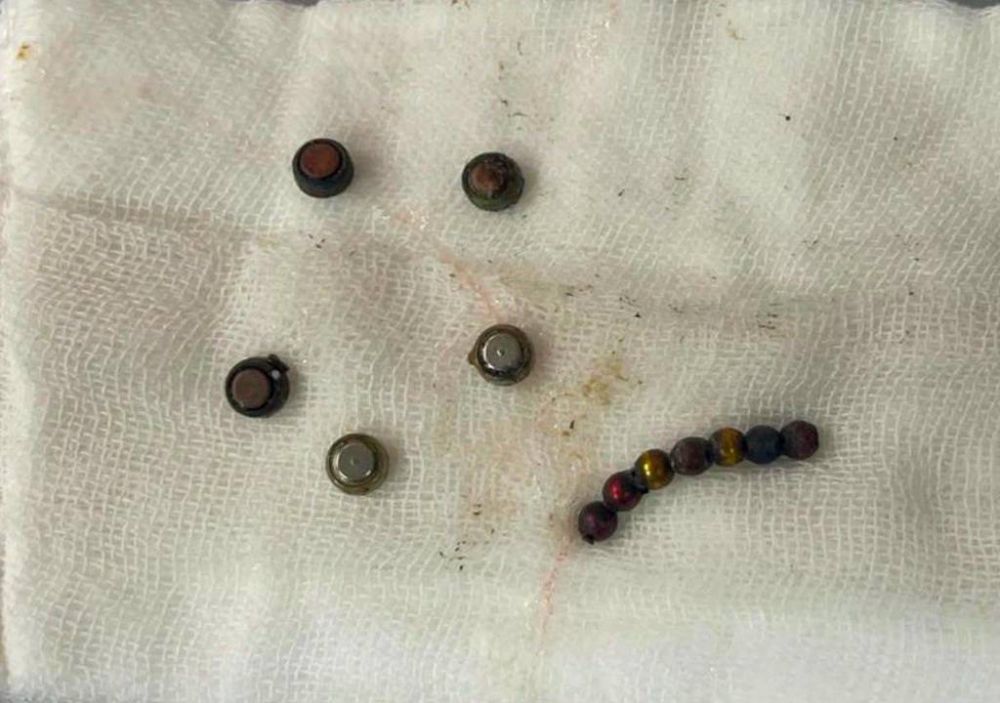 Mansoura University Children's Hospital successfully saved a child who had swallowed 20 objects using a combined endoscopic and surgical procedure